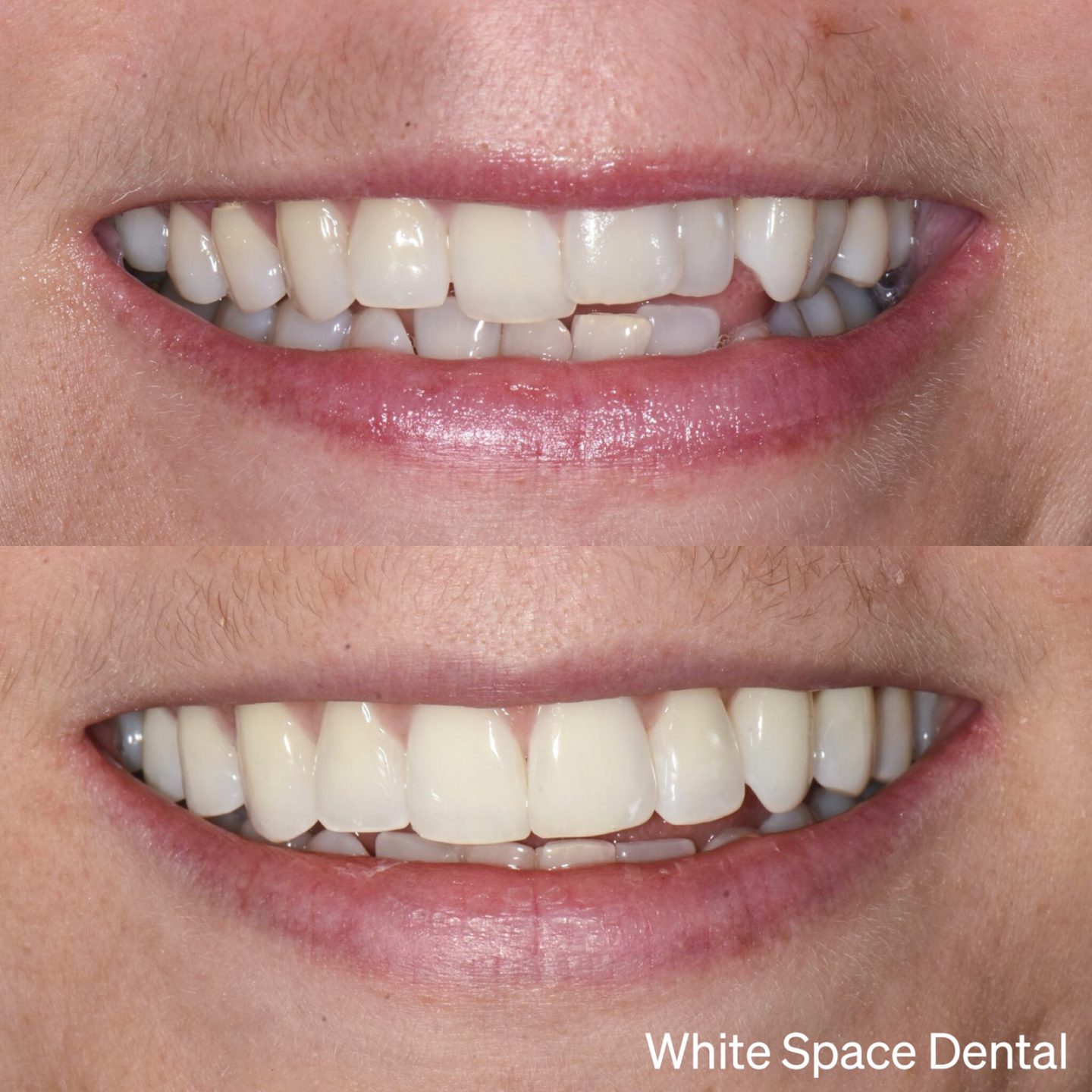 This patient received a straighter smile thanks to a virtually invisible treatment.