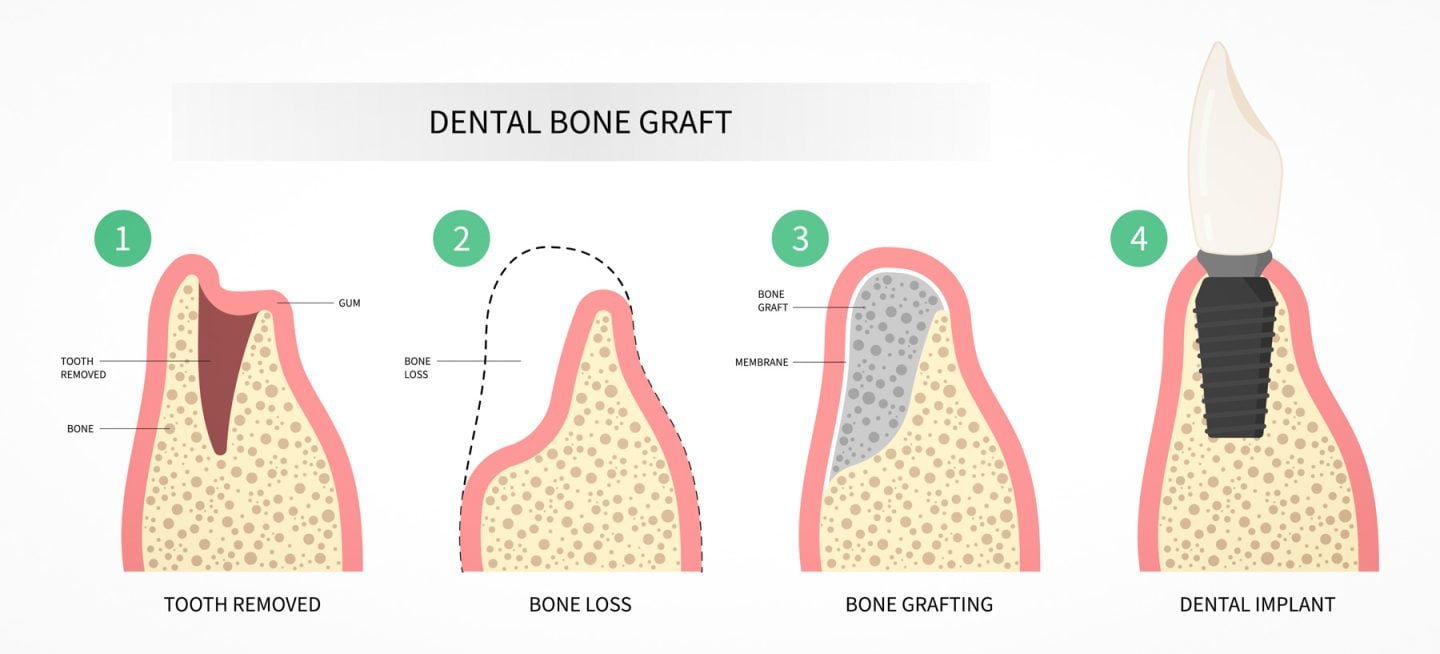 Dental Bone Graft Procedure diagram