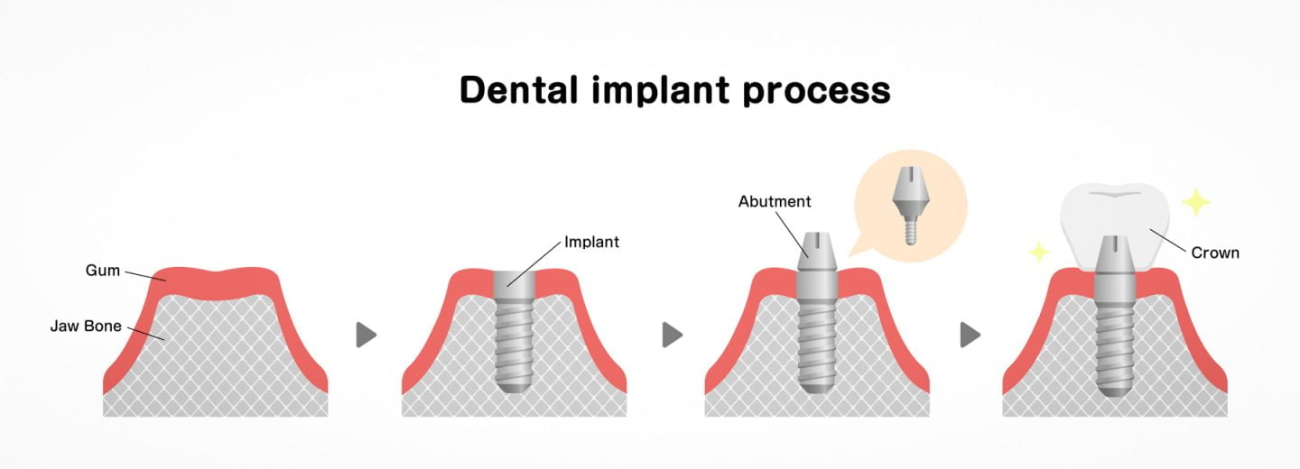 Dental Implant Process diagram