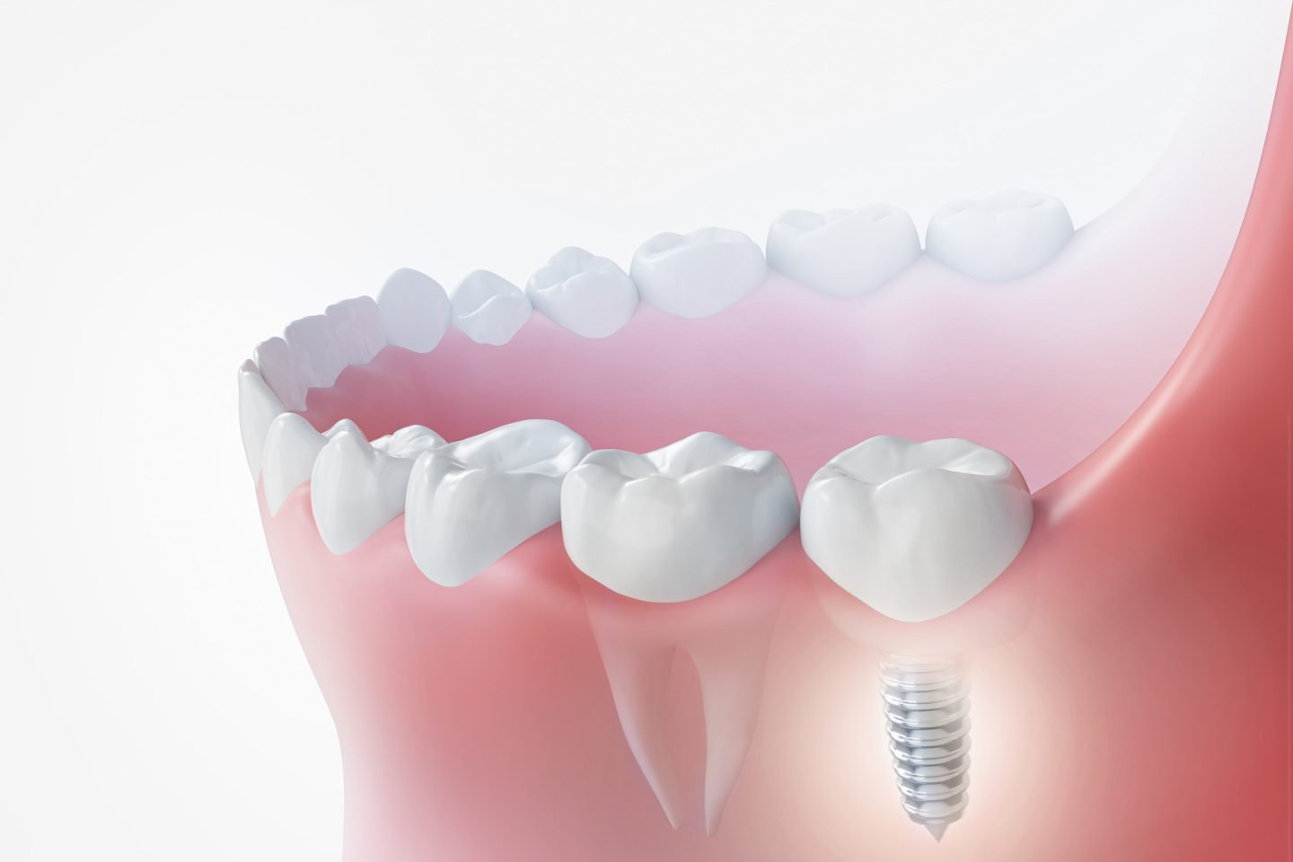 Dental Implant diagram