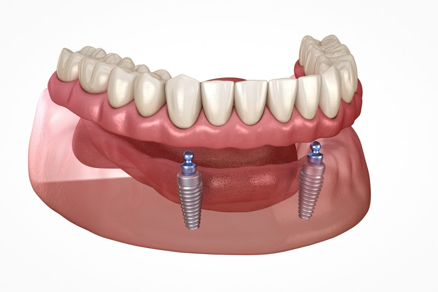 Dental Implant diagram