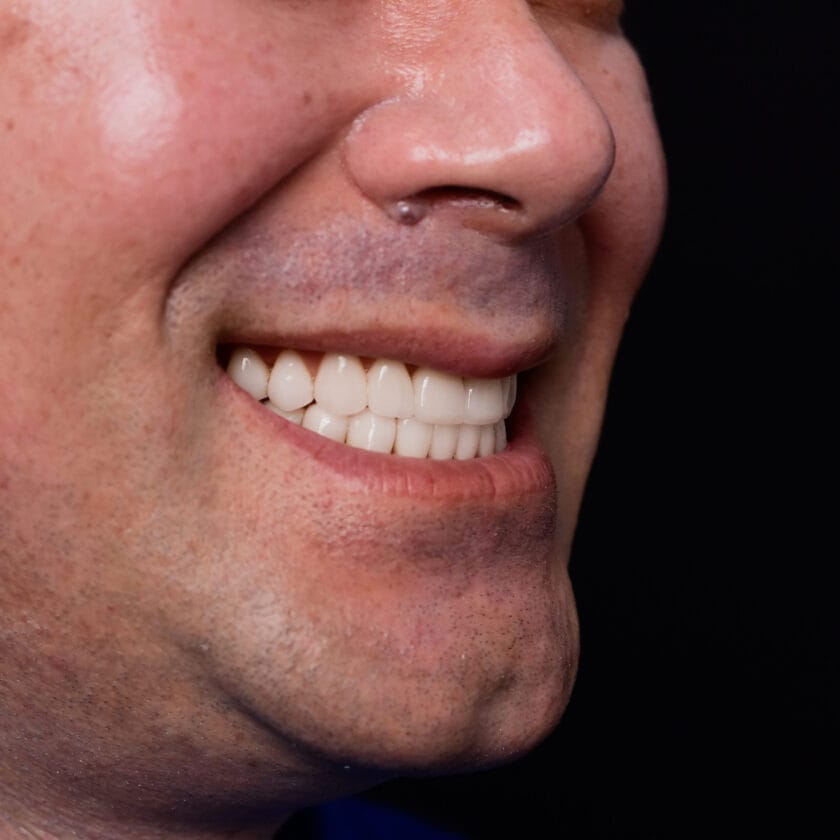 Crowns vs Veneers What’s the Difference