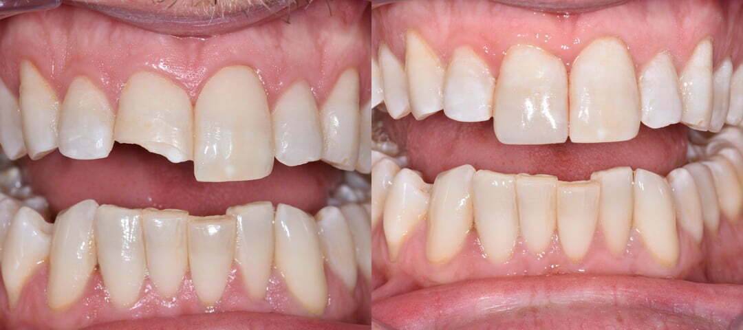 WSD Patient Case Before and After