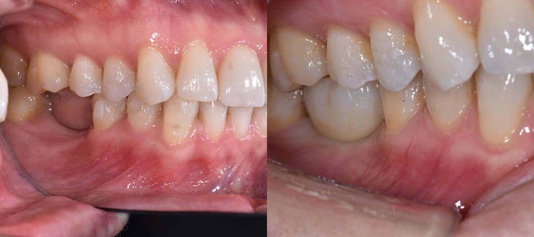 WSD Implant Patient Before and After